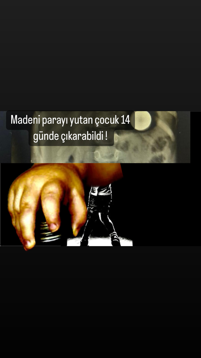 Çocuğun yuttuğu madeni para 14 günde çıktı